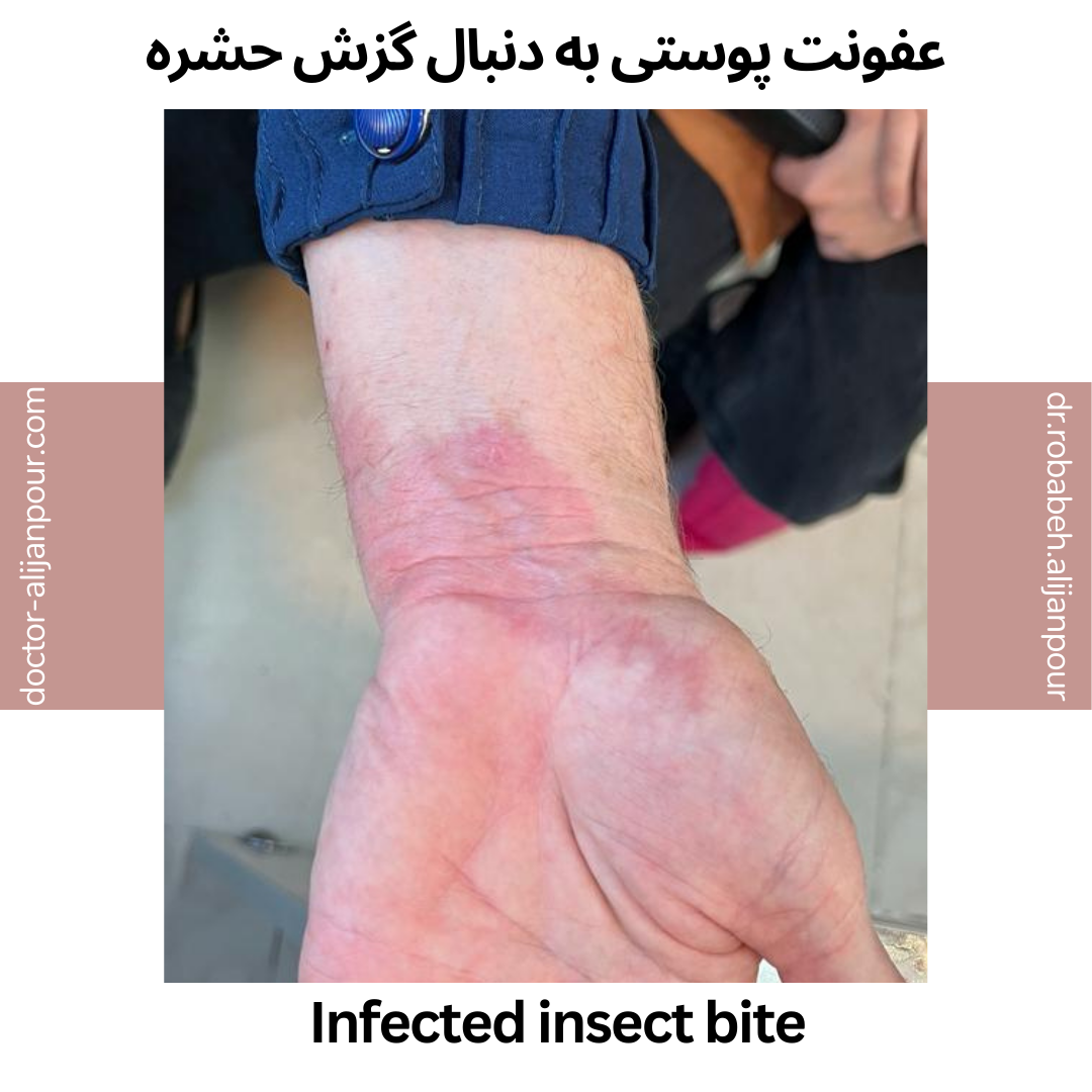 infected insect bite